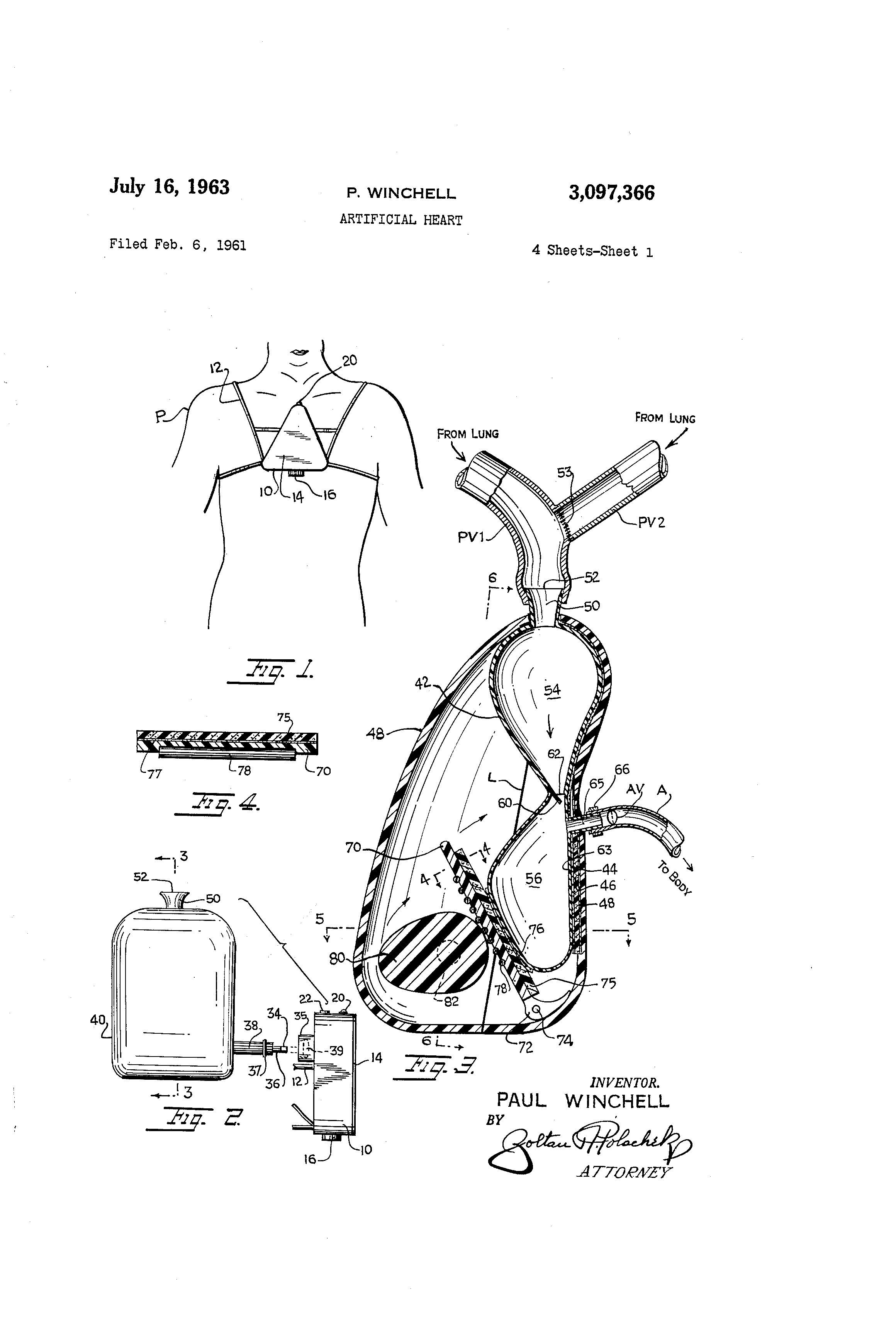 Heart patent clearance